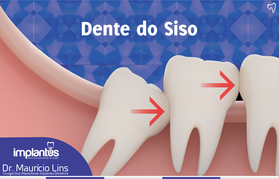 Cirurgia de Extração dos Sisos